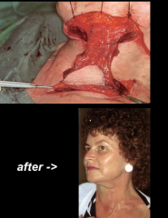 Maksilofacijalna kirurgija 11