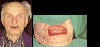 Maksilofacijalna kirurgija 4