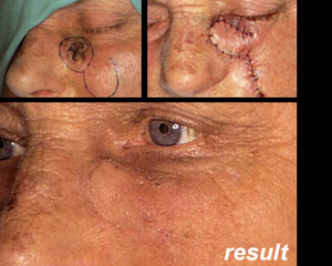 Maksilofacijalna kirurgija 5