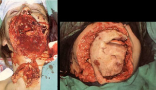 Maksilofacijalna kirurgija 1