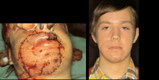 Maksilofacijalna kirurgija 2