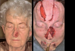 Maksilofacijalna kirurgija 3