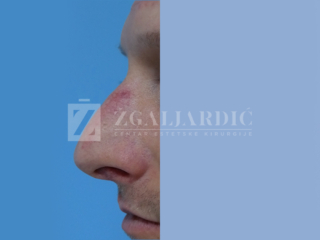 Korekcija nosa 2