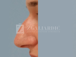 Korekcija nosa 5