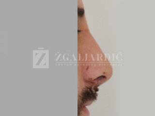 Korekcija nosa 6