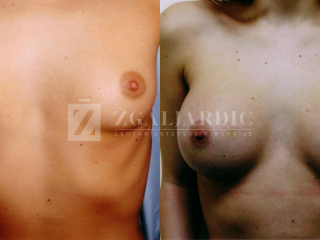 Povećanje grudi 14