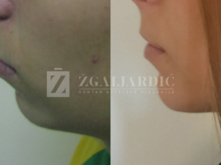 Korekcija brade ostetotomijom i koštanim transplantatom 1