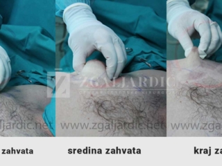 Kirurško tretiranje ginekomastije 8 - provjera količine potkožne masti tijekom operacije a)na početku, b)u sredini c)na kraju zahvata