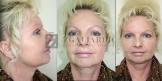 Zatezanje lica i vrata (Laserski lifting) 7