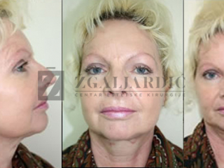 Zatezanje lica i vrata (Laserski lifting) 7