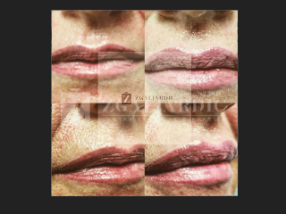 Hijaluronska kiselina – fileri 1