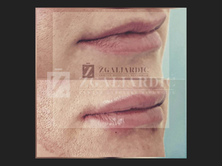 Hijaluronska kiselina – fileri 4