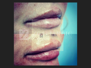 Hijaluronska kiselina – fileri 5