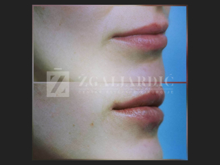 Hijaluronska kiselina – fileri 6