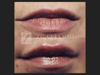 Hijaluronska kiselina – fileri 7