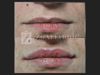 Hijaluronska kiselina – fileri 8