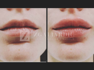 Hijaluronska kiselina – fileri 9