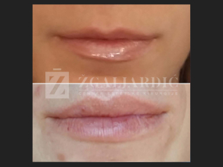 Hijaluronska kiselina – fileri 10