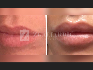 Hijaluronska kiselina – fileri 11