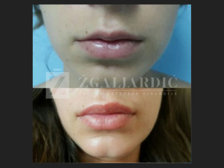 Hijaluronska kiselina – fileri 12