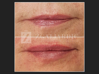 Hijaluronska kiselina – fileri 13