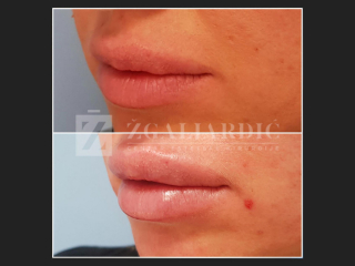 Hijaluronska kiselina – fileri 14