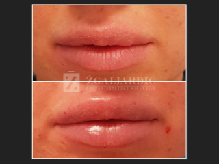 Hijaluronska kiselina – fileri 15