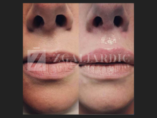 Hijaluronska kiselina – fileri 2