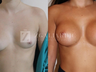 Galerija - Povecanje grudi 02