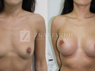 Galerija - Povecanje grudi 12