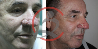 Zatezanje lica i vrata (Laserski lifting) 7