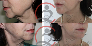 Zatezanje lica i vrata (Laserski lifting) 8