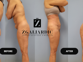 Lipoabdominoplastika- zatezanje viseće kože trbuha 7
