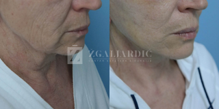 Zatezanje lica i vrata (Laserski lifting) 1