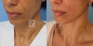 Zatezanje lica i vrata (Laserski lifting) 2