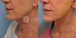 Zatezanje lica i vrata (Laserski lifting) 3