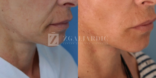 Zatezanje lica i vrata (Laserski lifting) 4