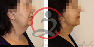 Zatezanje lica i vrata (Laserski lifting) 11