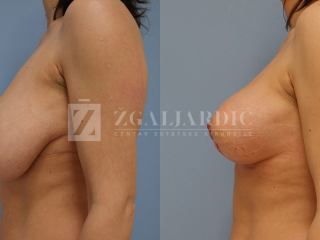 Redukcija grudi i podizanje