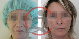 Zatezanje lica i vrata (Laserski lifting) 10