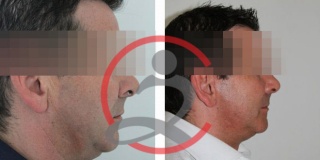 Zatezanje lica i vrata (Laserski lifting) 9