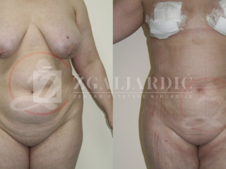 Laser lipo 11