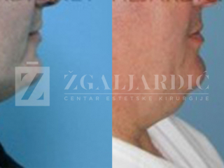 Korekcija podbratka 8