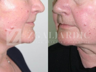 Korekcija podbratka 7