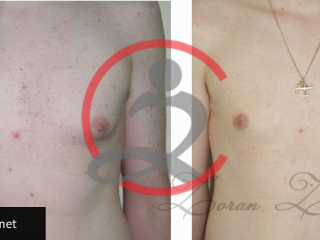 Laserski asistirana liposukcija 4