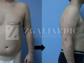Laser lipo 6