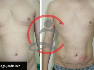 Laser lipo 1