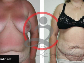 Laser lipo 2