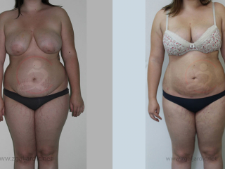 Laser lipo 8