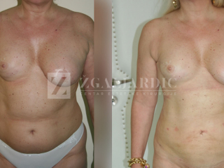 Laser lipo 10